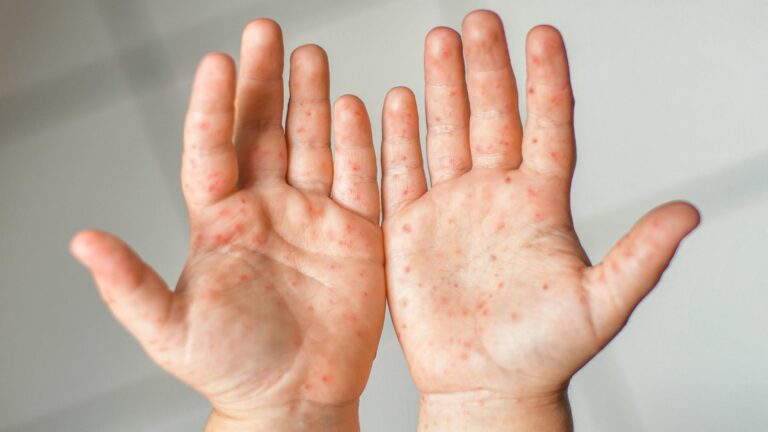 hand fuß mund krankheit